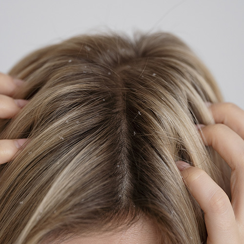 Les 10 meilleurs shampooings antipelliculaires