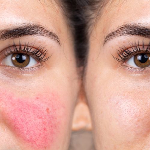 Do you have rosacea? Here's how a gentle, well-chosen skincare routine can help you.