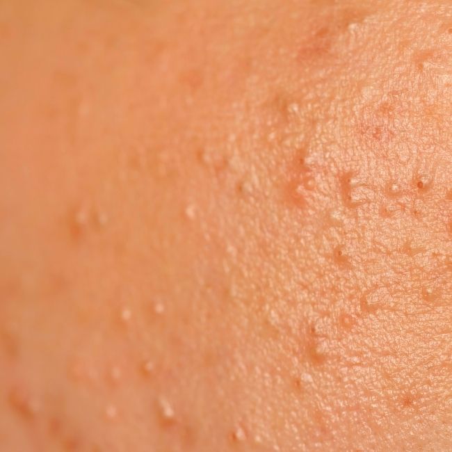 Comment prévenir l'apparition de boutons de transpiration cet été et garder une peau nette