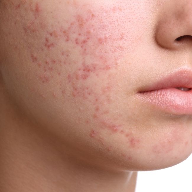 Comment se débarrasser des cicatrices d'acné ?