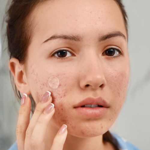 Comment se débarrasser des cicatrices d'acné ?