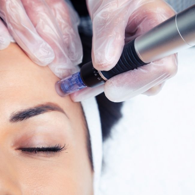 Facial microneedling: what it involves and what you can expect