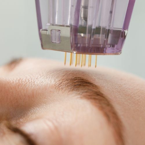 Facial microneedling: what it involves and what you can expect