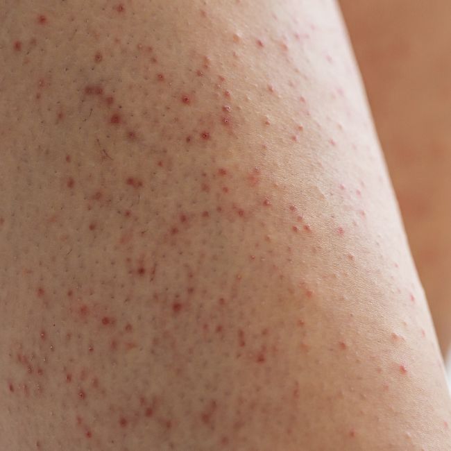 Ceratose pilar: porque aparece e como cuidar da pele áspera.