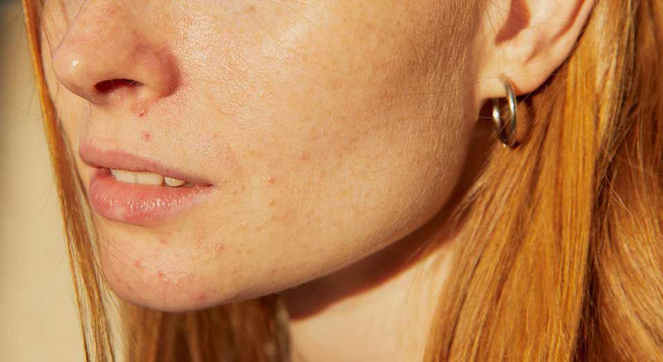 acne fr